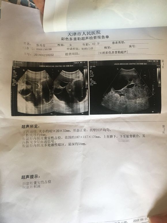 请问大家这能确定是卵巢癌吗？大概到几期了？谢谢