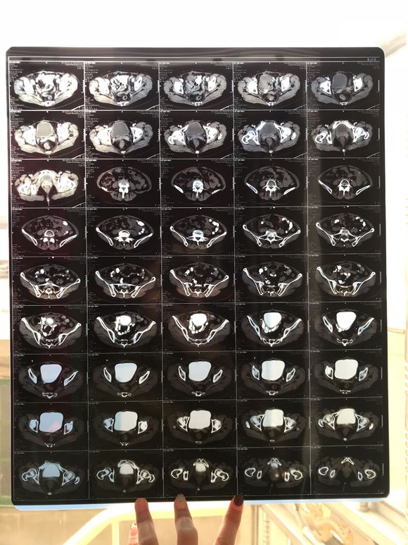 有子宫肉瘤的吗？