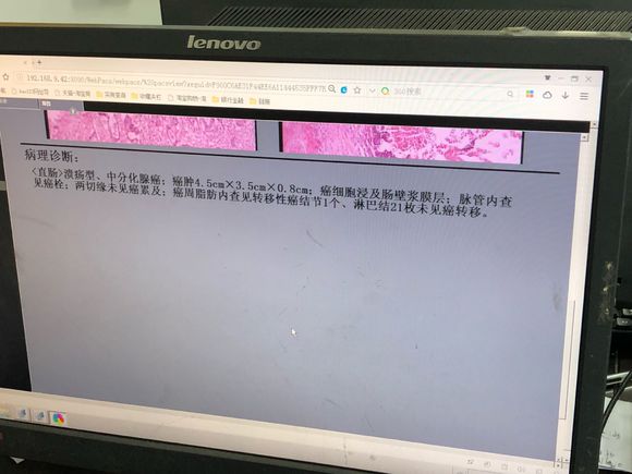 爷爷刚做了直肠癌切除手术想问下病理分期是几期？