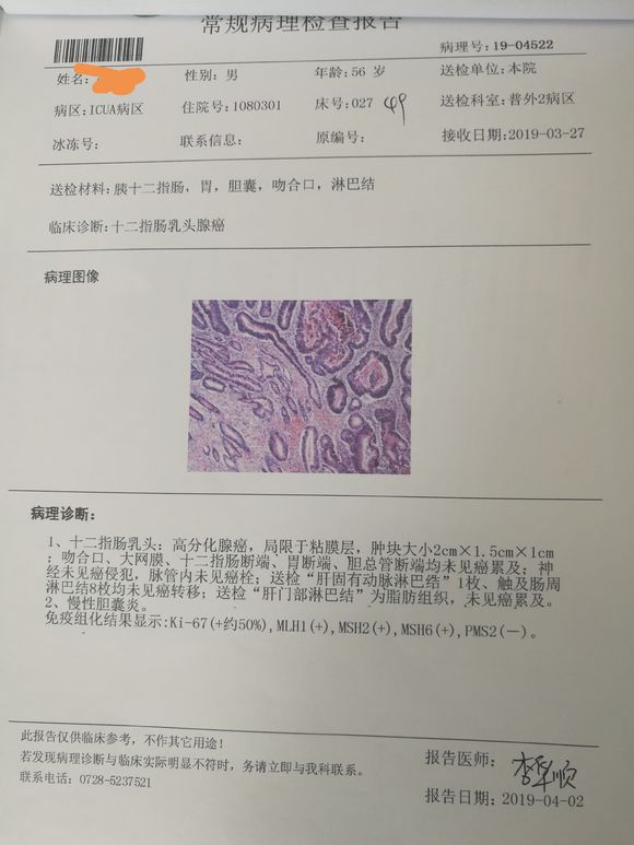 关于十二指肠乳头腺癌希望有吧友能够解答一下