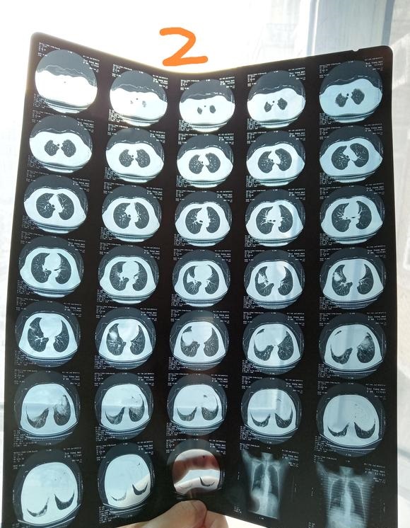 医生说姥姥可能是肺癌麻烦大家帮忙看一下万分感谢