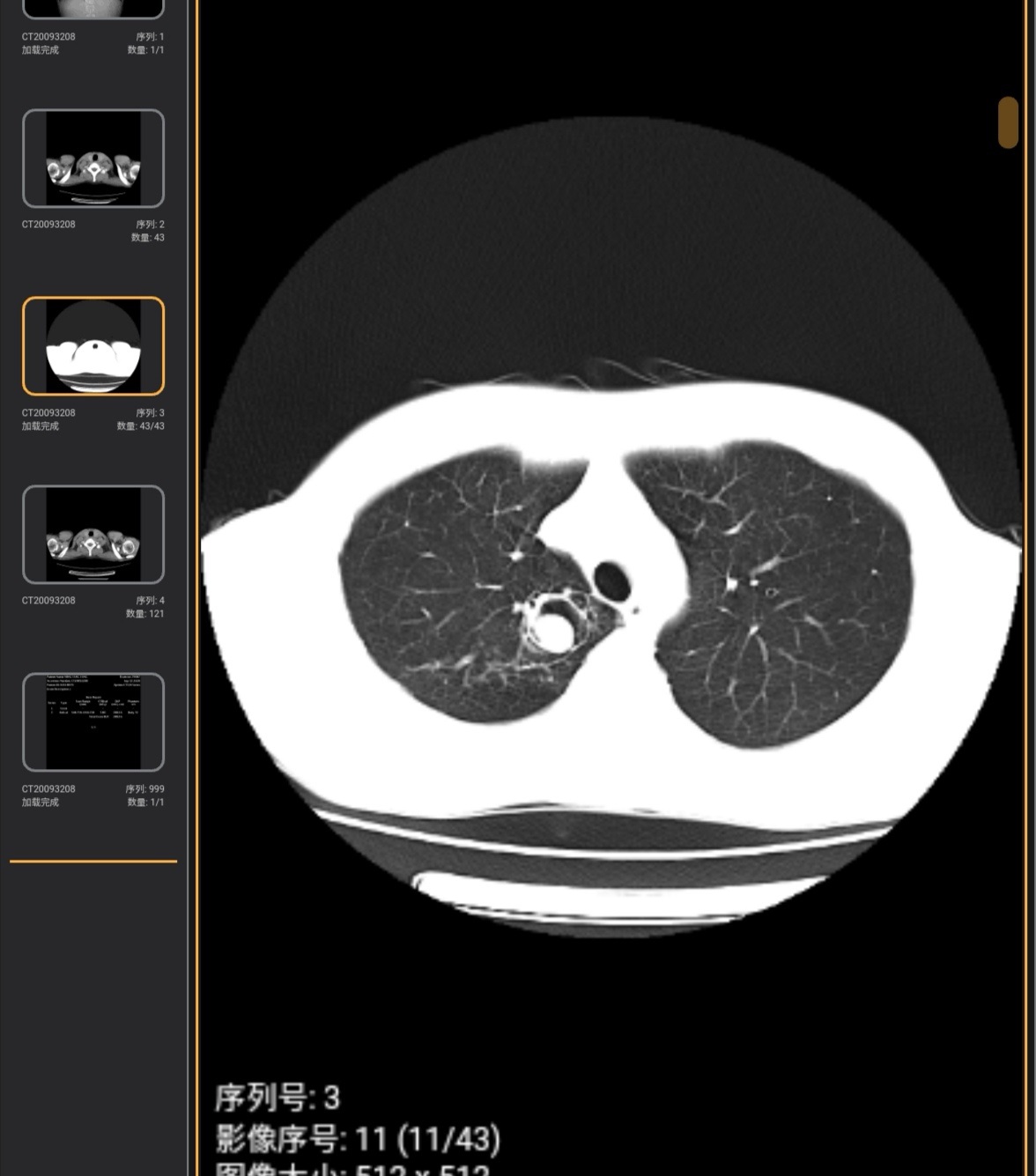 有没有懂的大哥，这是不是肿瘤啊