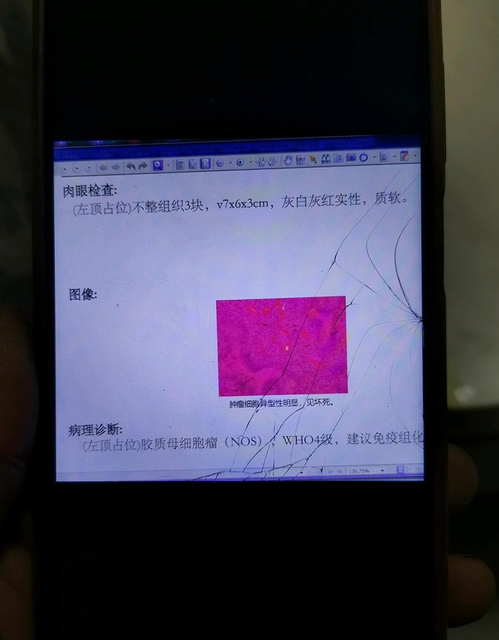 大神们胶质瘤恶性，谁能看懂这个，已经手术全切